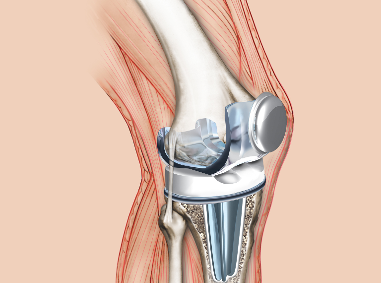 Latest Surgical Procedures for Joint Replacement Surgeries