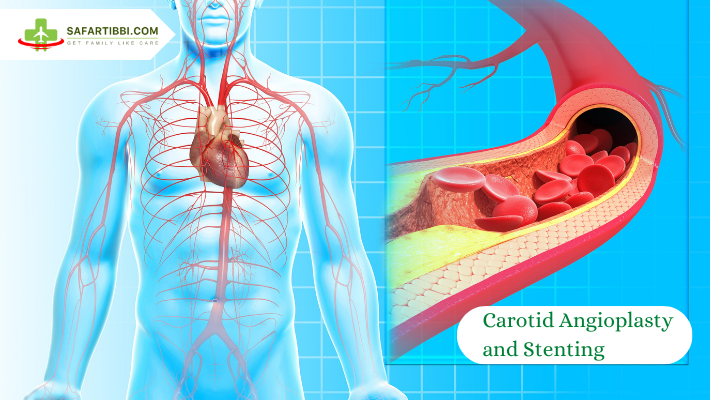 Carotid Angioplasty and Stenting: Advanced Treatment for Vascular Health