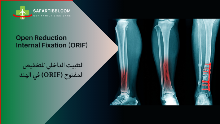Open Reduction Internal Fixation (ORIF) in India