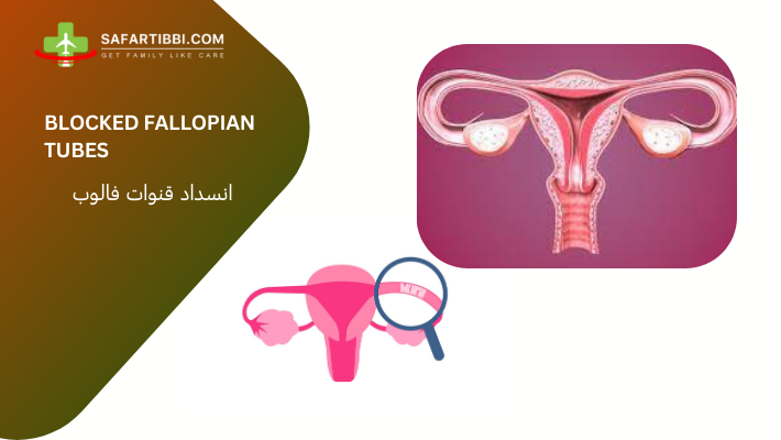 Treatment Options for Blocked Fallopian Tubes in India - Safartibbi