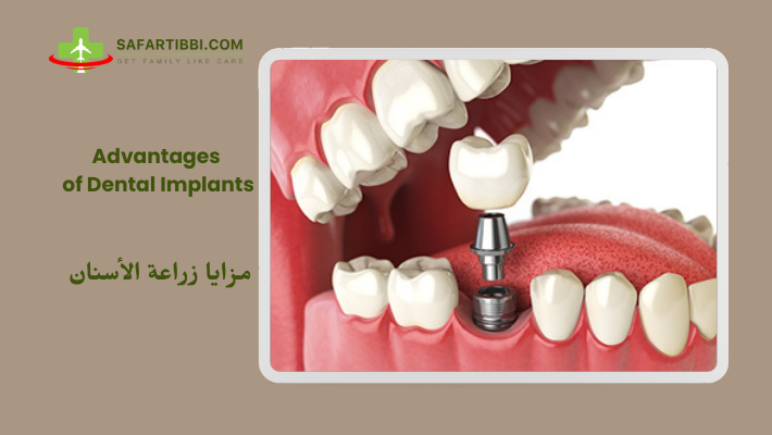 Advantages of Dental Implants