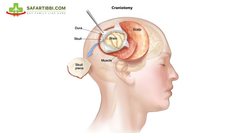 Craniotomy in India: Everything You Need to Know - Safartibbi