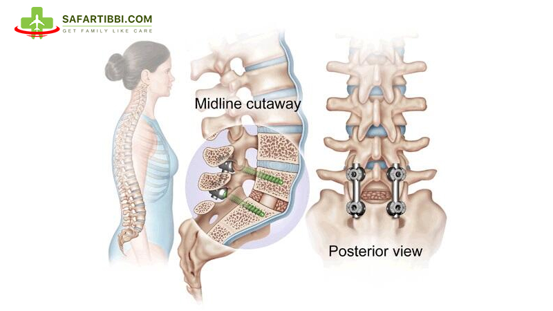 Spinal Fusion Surgery: Exploring Treatment Options in India