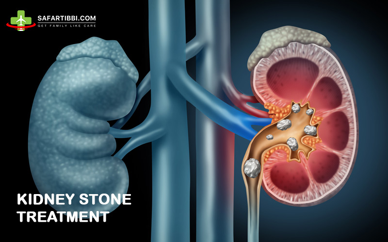 Kidney Stone Treatment in India | Advanced & Affordable Care