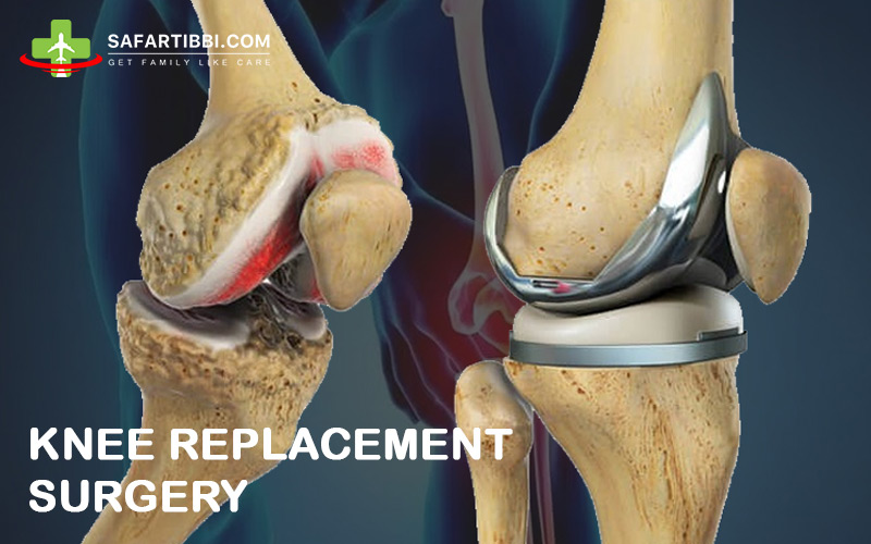 Recovery After a Total Knee Replacement Surgery